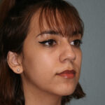 Nose Surgery (Rhinoplasty)