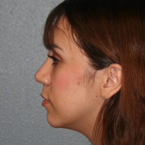 Nose Surgery (Rhinoplasty)