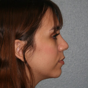 Nose Surgery (Rhinoplasty)