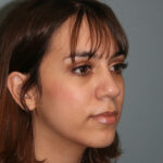 Nose Surgery (Rhinoplasty)