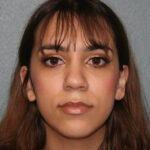 Nose Surgery (Rhinoplasty)