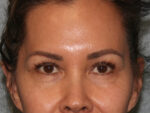 Eyelid Surgery