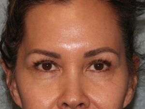 Eyelid Surgery