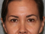 Eyelid Surgery