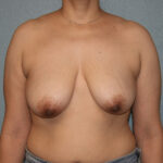 Breast Lift