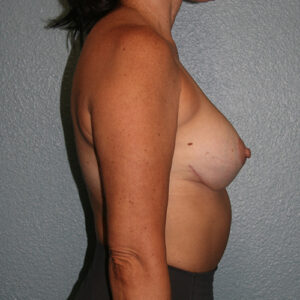 Breast Lift