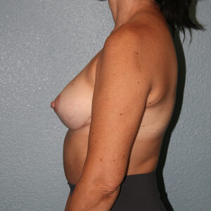 Breast Lift