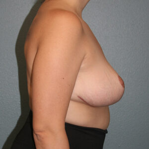 Breast Reduction
