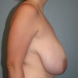 Breast Reduction