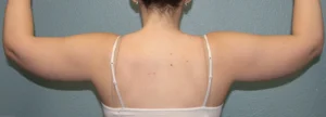 Liposuction