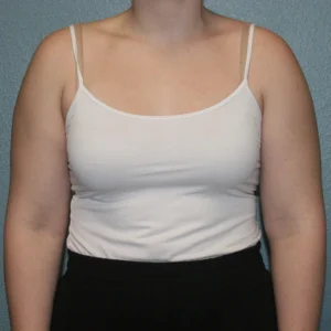Liposuction