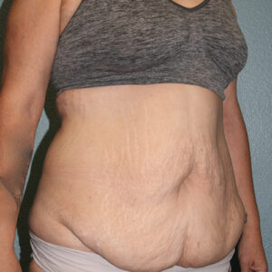 Tummy Tuck