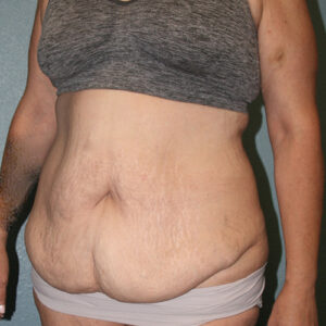 Tummy Tuck