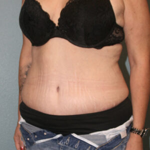 Tummy Tuck