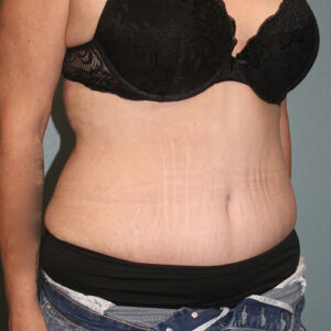 Tummy Tuck