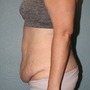 Tummy Tuck
