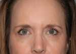 Eyelid Surgery