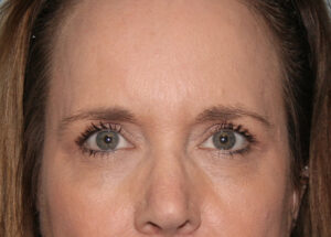 Eyelid Surgery