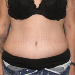 Tummy Tuck
