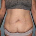 Tummy Tuck