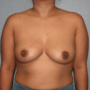 Breast Augmentation