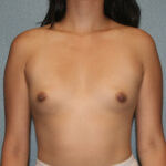 Breast Augmentation