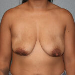 Breast Lift