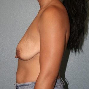 Breast Lift
