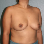 Breast Augmentation