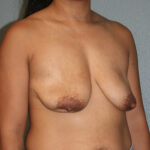Breast Lift