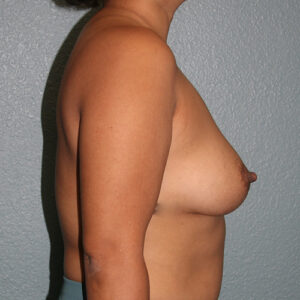Breast Augmentation