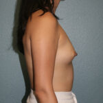 Breast Augmentation