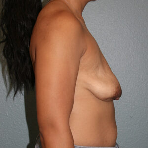 Breast Lift