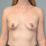 Breast Reduction