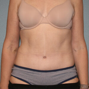 Tummy Tuck