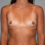 Breast Augmentation