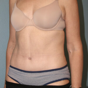 Tummy Tuck