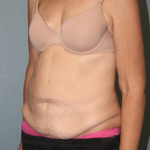 Tummy Tuck