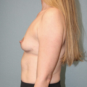 Breast Reduction