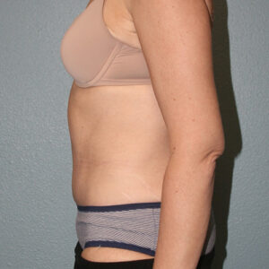 Tummy Tuck