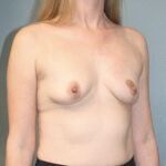 Breast Reduction