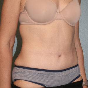 Tummy Tuck