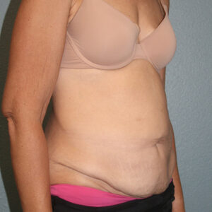 Tummy Tuck