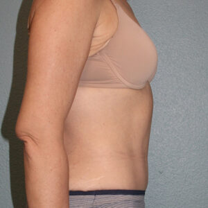Tummy Tuck