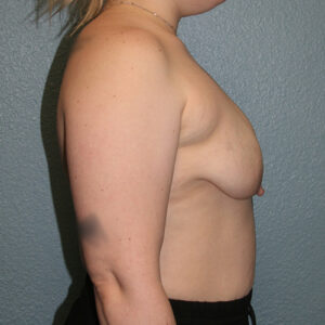 Breast Lift