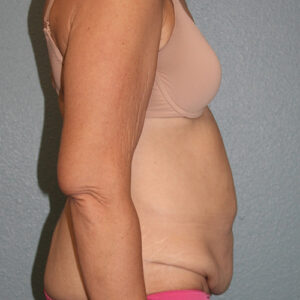 Tummy Tuck