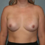 Breast Augmentation