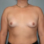 Breast Augmentation