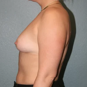 Breast Augmentation