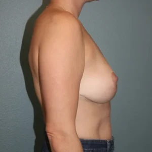 Breast Lift